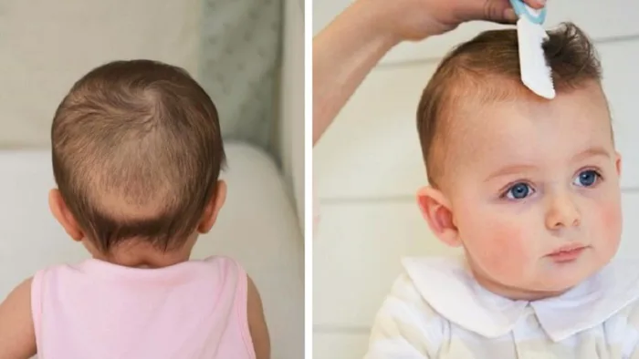 Bật mí cho mẹ cách chữa rụng tóc vành khăn hiệu quả nhất