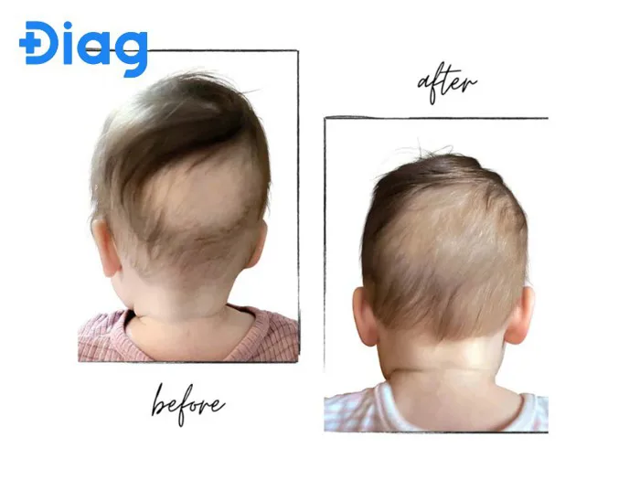 Rụng tóc vành khăn thiếu chất gì? Cách xử lý hiệu quả - Diag