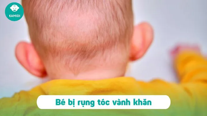 Rụng tóc vành khăn ở trẻ sơ sinh: Nguyên nhân và cách điều trị