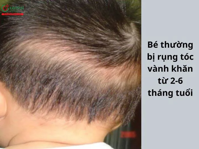 Dấu hiệu rụng tóc vành khăn ở trẻ. Rụng tóc vành khăn có nguy hiểm không?