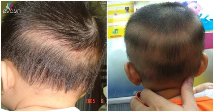 Cách điều trị rụng tóc vành khăn ở trẻ sơ sinh đơn giản, hiệu quả