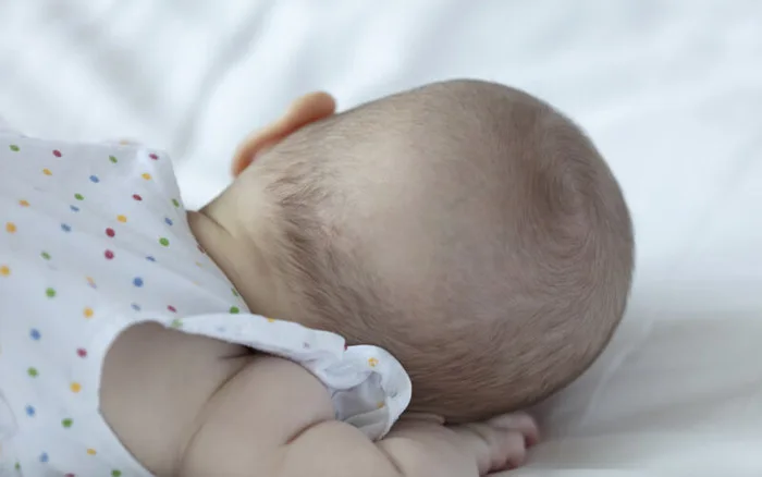 Nguyên nhân, dấu hiệu và cách điều trị rụng tóc vành khăn ở trẻ nhỏ