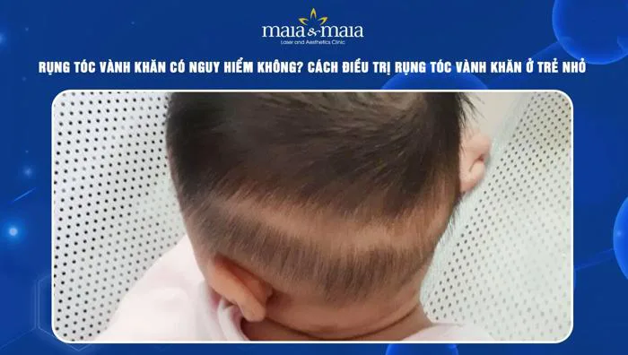 Rụng tóc vành khăn có nguy hiểm không? Lưu ý để phòng ngừa