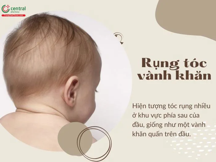 Dấu hiệu rụng tóc vành khăn ở trẻ. Rụng tóc vành khăn có nguy hiểm không?