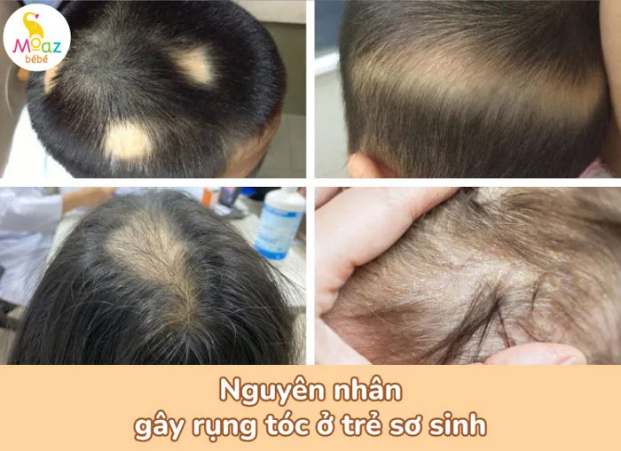 Rụng tóc vành khăn ở trẻ sơ sinh: Nguyên nhân và cách khắc phục