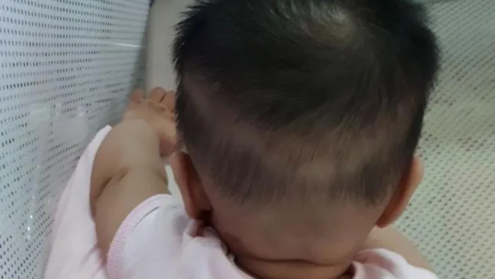 Trẻ rụng tóc vành khăn không phải do thiếu can xi, bác sĩ lý giải nguyên  nhân bất ngờ