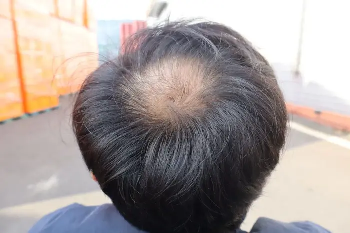 Nguyên nhân khiến tóc thưa ở đỉnh đầu nam và giải pháp khắc phục hiệu quả Nguyên nhân khiến tóc thưa ở đỉnh đầu nam và giải pháp khắc phục hiệu quả