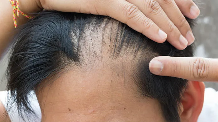 Rụng tóc hói đầu ở nam giới, nguyên nhân và cách khắc phục Rụng tóc hói đầu ở nam giới, nguyên nhân và cách khắc phục