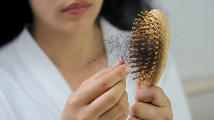 Rụng tóc là bệnh gì? Nguyên nhân, triệu chứng và điều trị Rụng tóc là bệnh gì? Nguyên nhân, triệu chứng và điều trị
