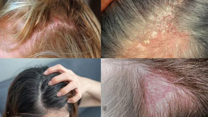 Rụng tóc ở tuổi dậy thì là gì? Có sao không? Có các cách chữa trị nào? Rụng tóc ở tuổi dậy thì là gì? Có sao không? Có các cách chữa trị nào?