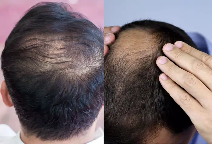 Rụng tóc nhiều có phải bị ung thư không? Có nghiêm trọng không? - Khoa Da Liễu Thẩm Mỹ Da - Bệnh viện Đại Học Y Dược TPHCM Rụng tóc nhiều có phải bị ung thư không? Có nghiêm trọng không? - Khoa Da Liễu Thẩm Mỹ Da - Bệnh viện Đại Học Y Dược TPHCM