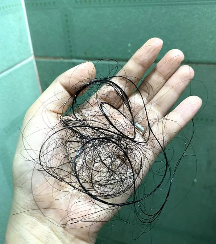 Rụng tóc nhiều phát sốc, phải làm sao? - Tuổi Trẻ Online Rụng tóc nhiều phát sốc, phải làm sao? - Tuổi Trẻ Online