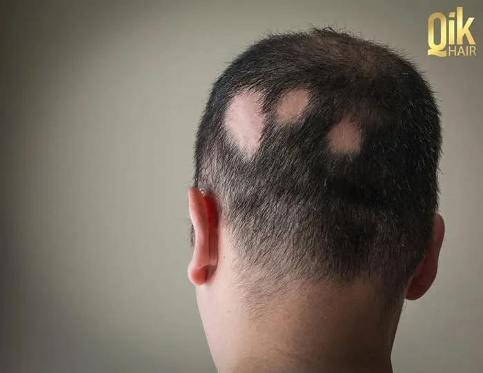 9 cách trị tóc thưa mỏng cho nam, nữ: Nguyên nhân và chăm sóc 9 cách trị tóc thưa mỏng cho nam, nữ: Nguyên nhân và chăm sóc