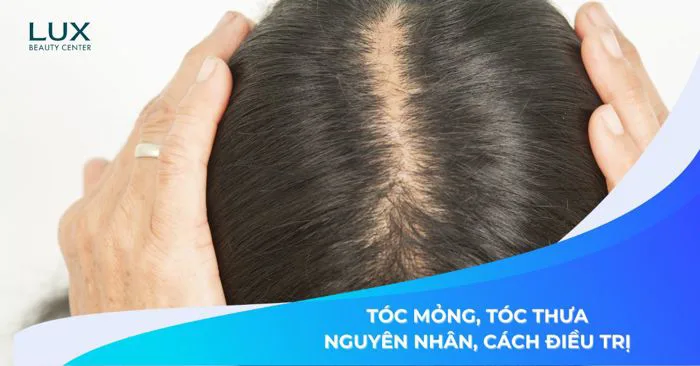 TÓC MỎNG, TÓC THƯA: NGUYÊN NHÂN DO ĐÂU? CÁCH NHẬN BIẾT & ĐIỀU TRỊ TÓC MỎNG, TÓC THƯA: NGUYÊN NHÂN DO ĐÂU? CÁCH NHẬN BIẾT & ĐIỀU TRỊ