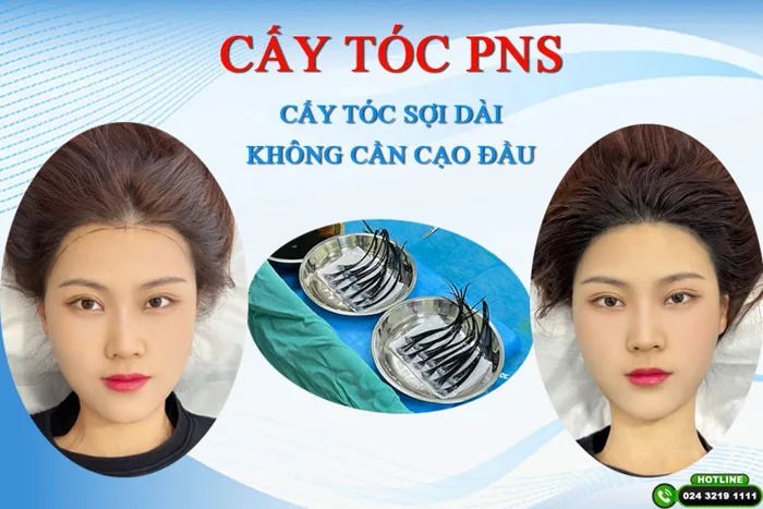 Cấy tóc PNS - Công nghệ cấy tóc sợi dài không cần cạo đầu