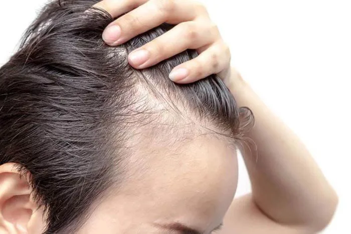 Nang tóc bị chết: Bạn có thể làm gì tại nhà? | Vinmec