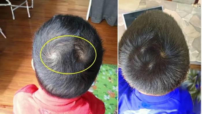 Xoáy tóc trên đầu có liên quan tới chỉ số IQ, tương lai thành công giàu có  của trẻ?