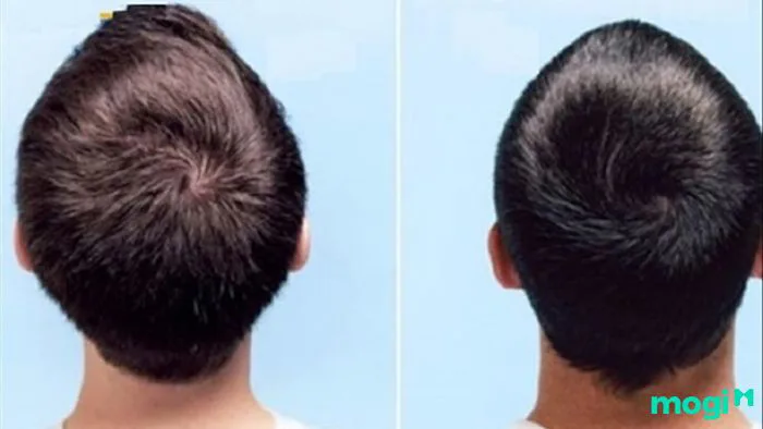 Xoáy Tóc Là Gì? Phân Tích Vận Mệnh Con Người Qua Dấu Hiệu Xoáy Tóc