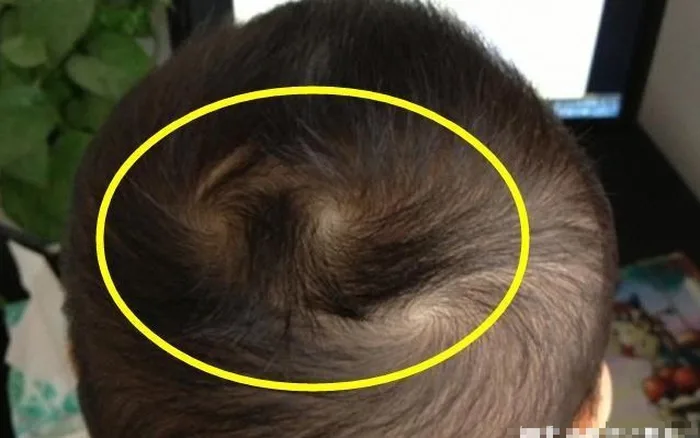Trẻ có 2 xoáy tóc dễ có IQ hơn người? Chuyên gia giải đáp và chỉ ra nếu có  4 dấu hiệu sau thì đích thị là thiên tài