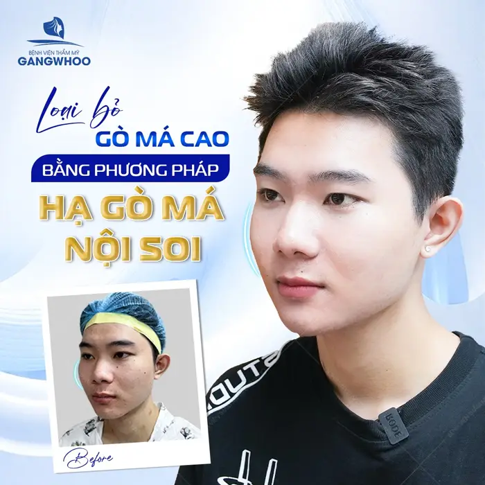 Hạ Gò Má Cho Nam Giới Có Cần Thiết Không? Nên Lưu Ý Những Gì