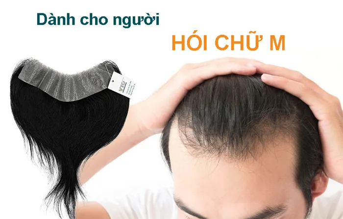 TOP 18+ kiểu tóc nam dành cho trán hói chữ M TOP 18+ kiểu tóc nam dành cho trán hói chữ M