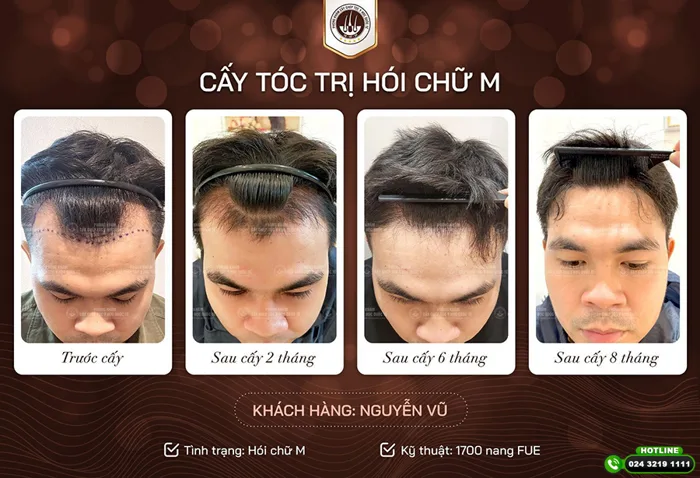 TOP 10 kiểu tóc cho người bị hói chữ M đẹp TOP 10 kiểu tóc cho người bị hói chữ M đẹp